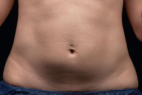 Case--7427 | Before Liposonix