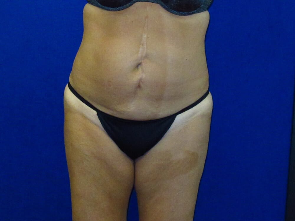 Case--2719 | Before Tummy Tuck