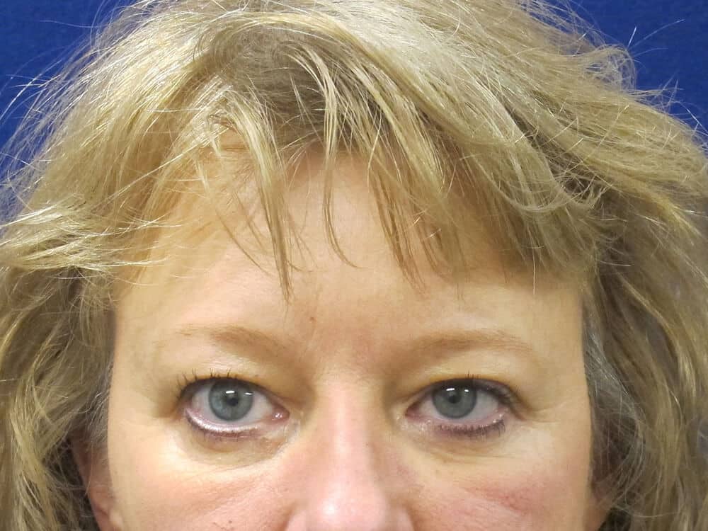 Case--2641 | Before Blepharoplasty