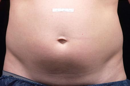 Case--7600 | Before Liposonix