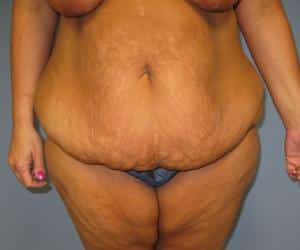 Case--2161 | Before Lower Body Lift