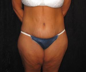 Case--2161 | After Lower Body Lift