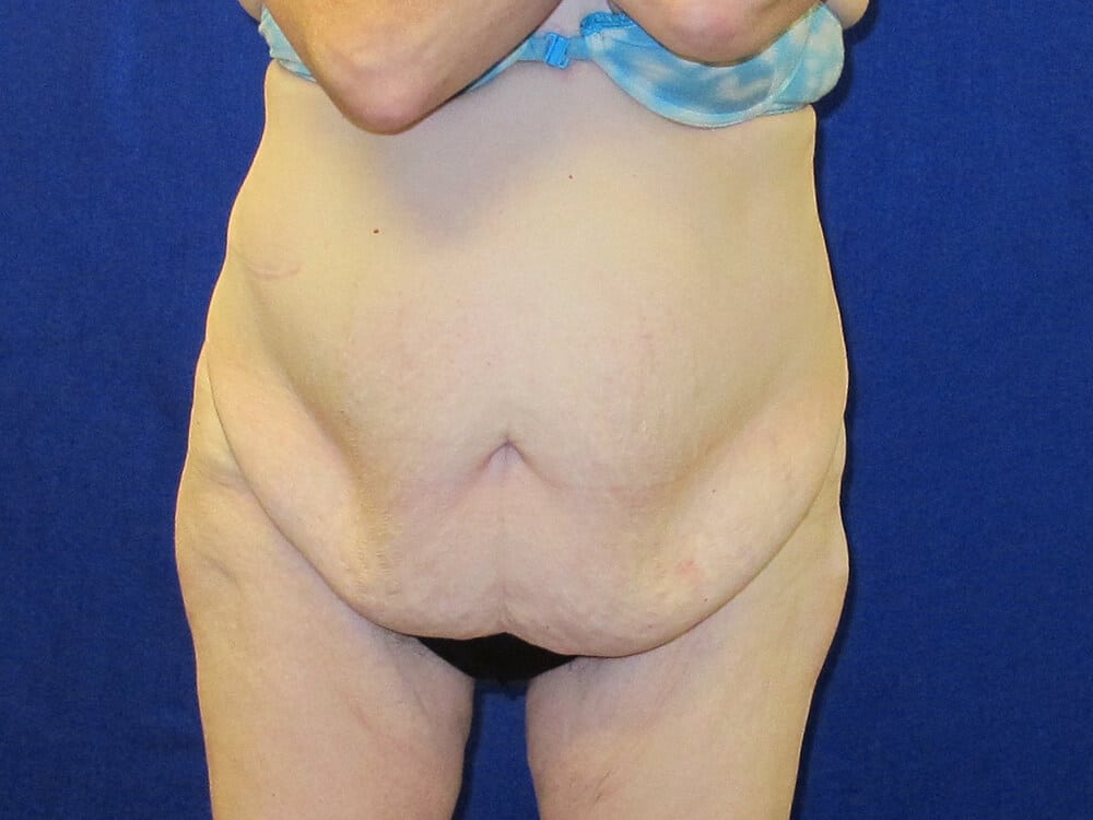 Case--6254 | Before Tummy Tuck