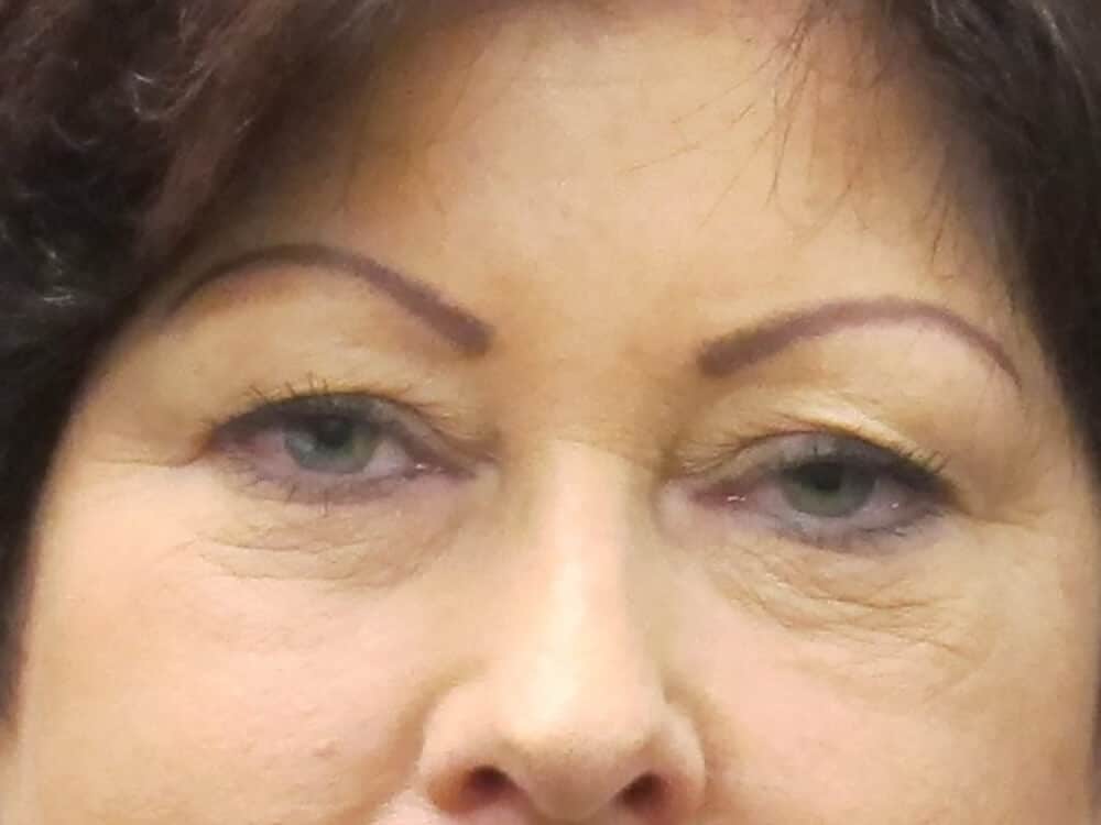 Case--8530 | Before Blepharoplasty
