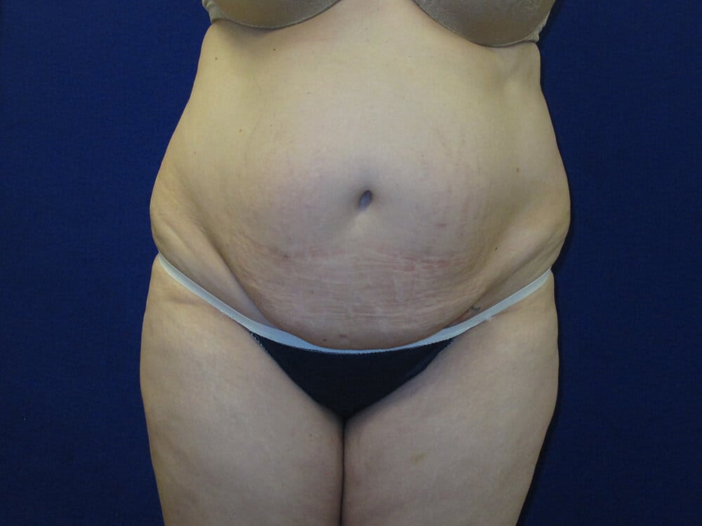 Case--9283 | Before Tummy Tuck