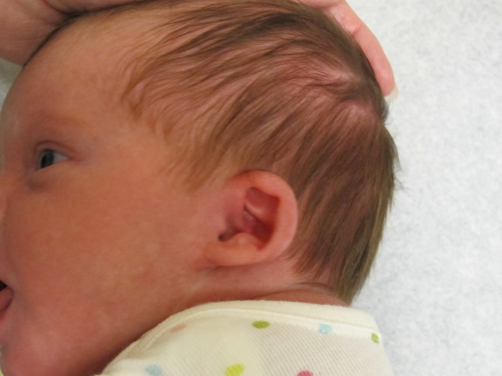 Case--8045 | Before EarWell™