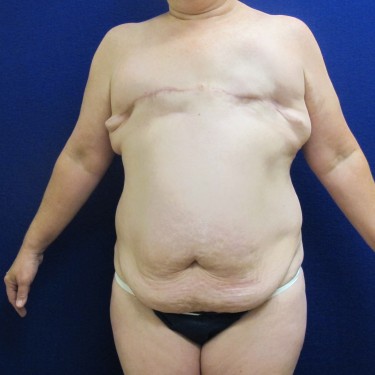 Breast Reconstruction - Before