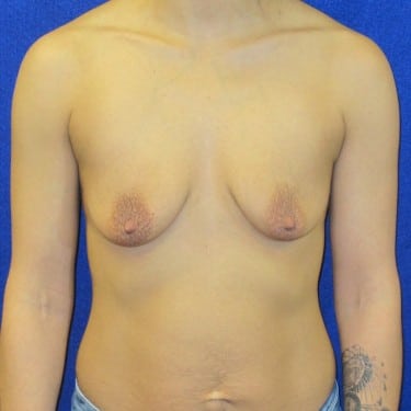 Breast Augmentation - Before