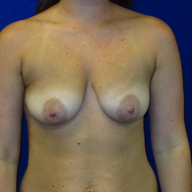 Breast Augmentation with Lift - Before