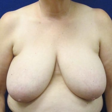 Breast Reduction - Before