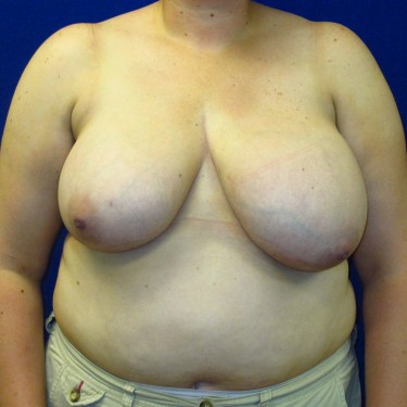 Breast Reduction - Before