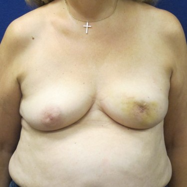 Breast Reconstruction - Before