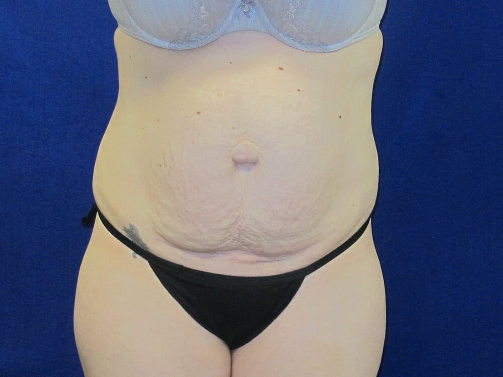 Case--7740 | Before Tummy Tuck