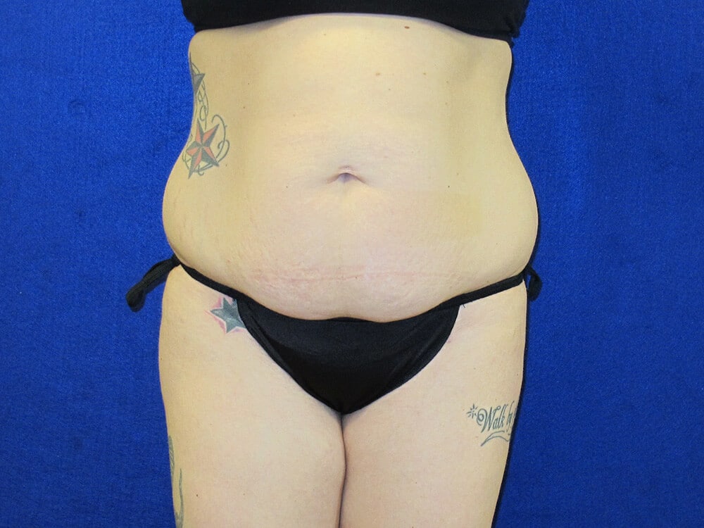 Case--3214 | Before Tummy Tuck