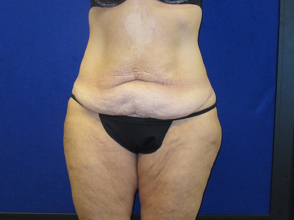 Case--2481 | Before Body