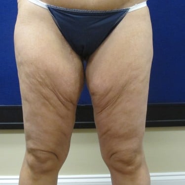 Thigh Lift - Before
