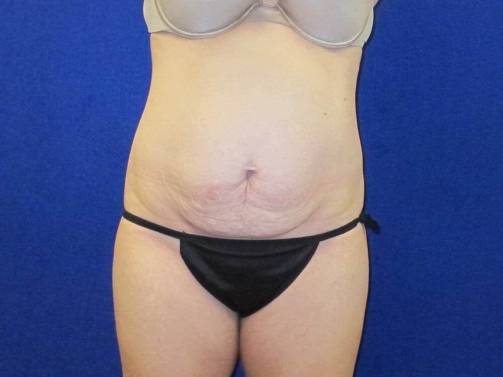Case--6928 | Before Tummy Tuck