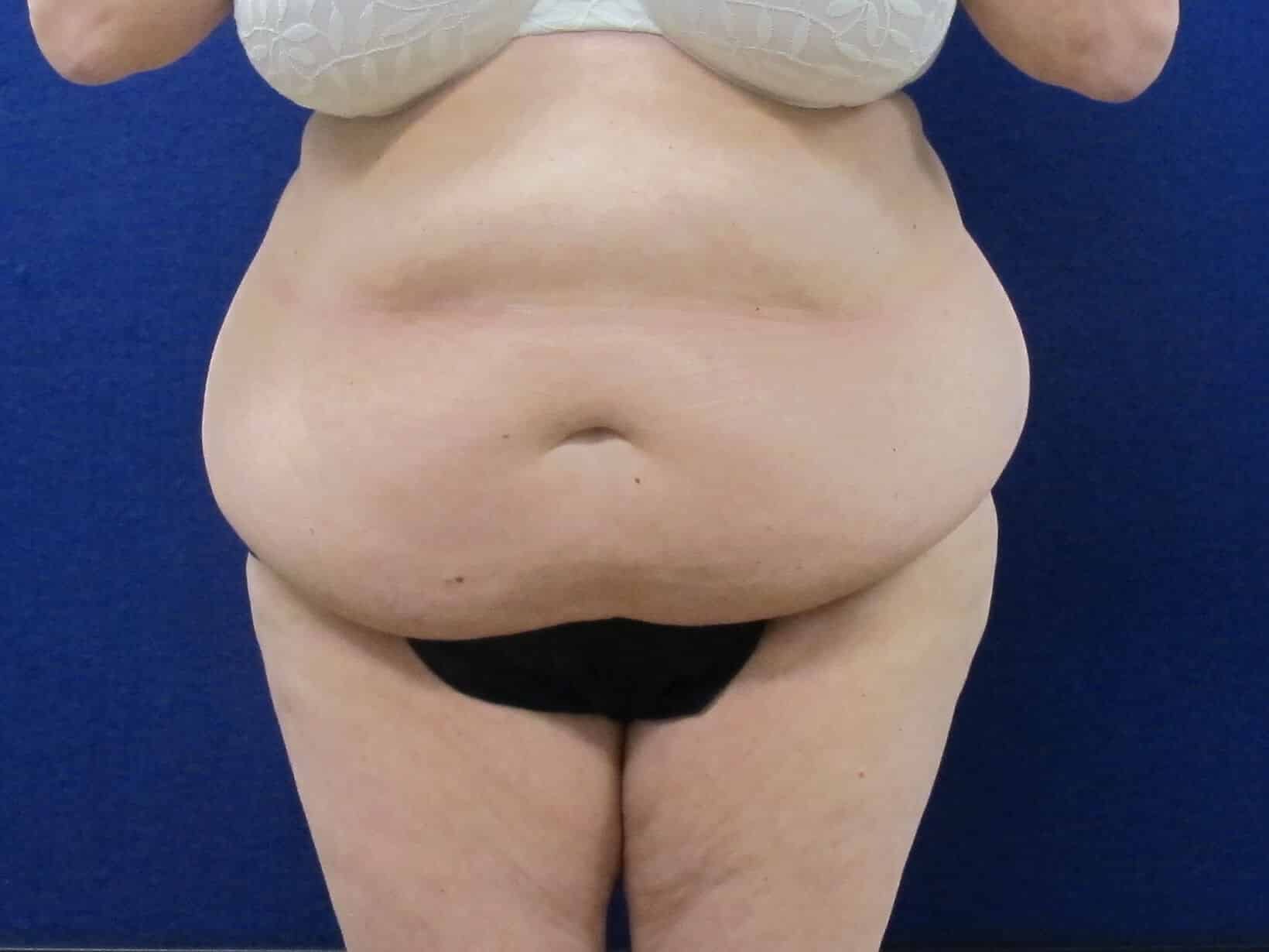 Case--1749 | Before Tummy Tuck