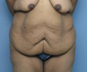 Case--3196 | Before Lower Body Lift