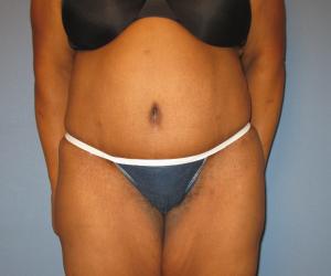 Case--3196 | After Lower Body Lift