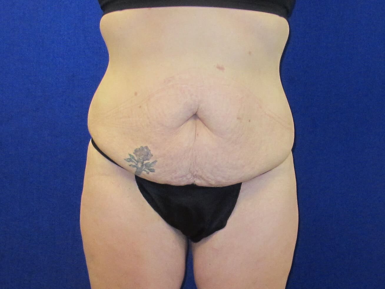Case--7026 | Before Tummy Tuck
