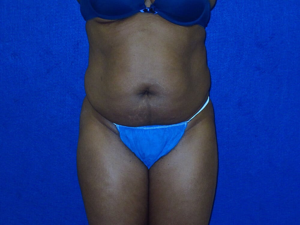 Case--1192 | Before Tummy Tuck