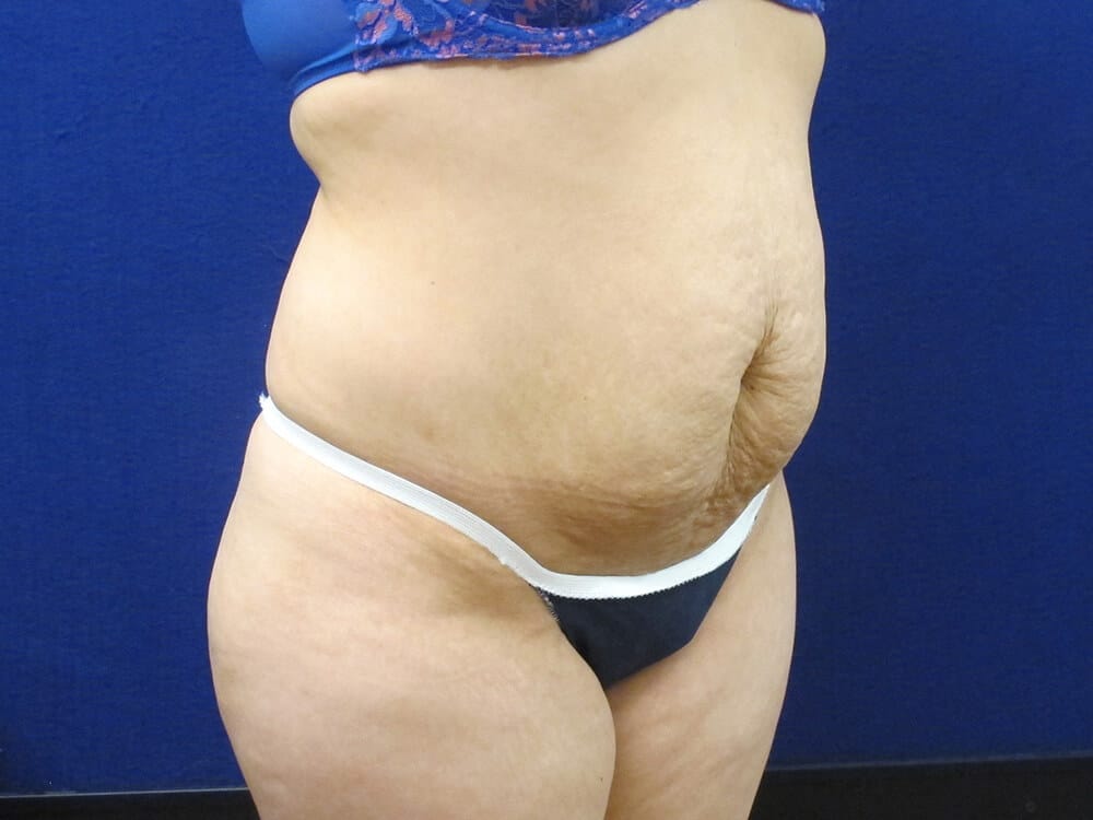 Case--6488 | Before Tummy Tuck