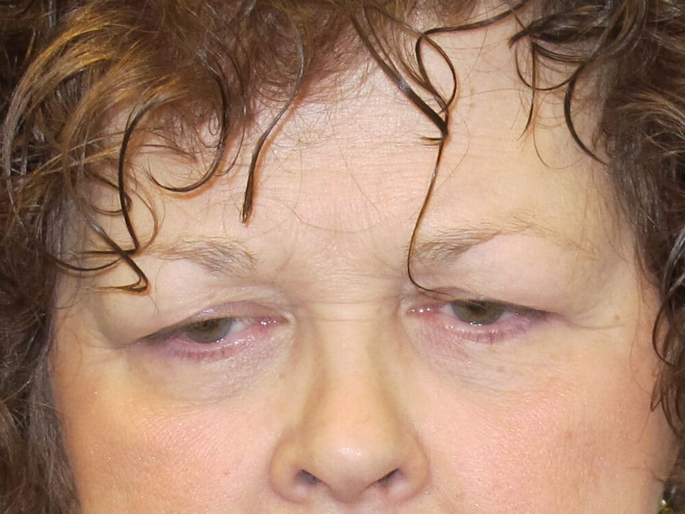 Case--6624 | Before Brow Lift