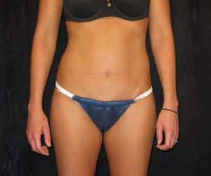 Case--2165 | After Tummy Tuck