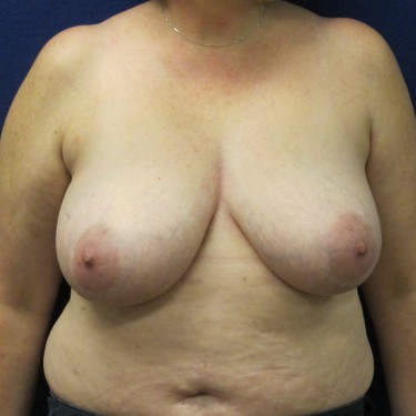 Breast Reduction - Before