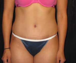 Case--8576 | After Tummy Tuck
