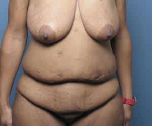 Case--6740 | Before Body