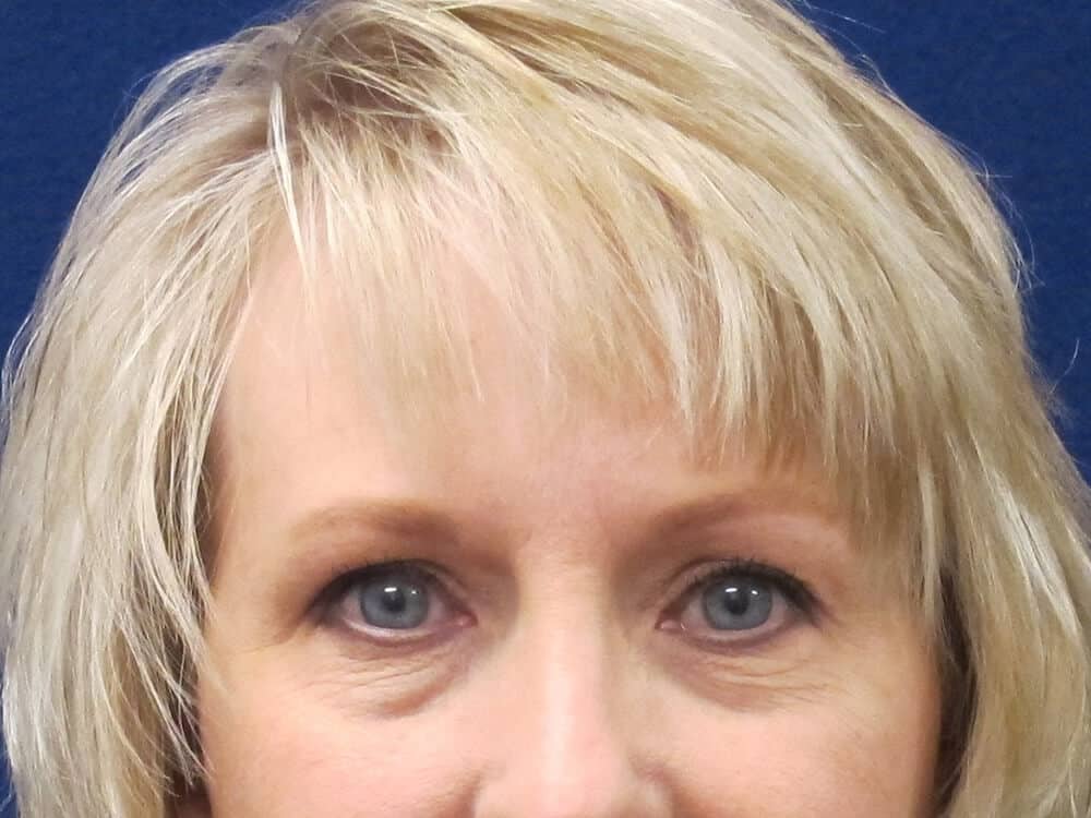 Case--9625 | Before Injectables