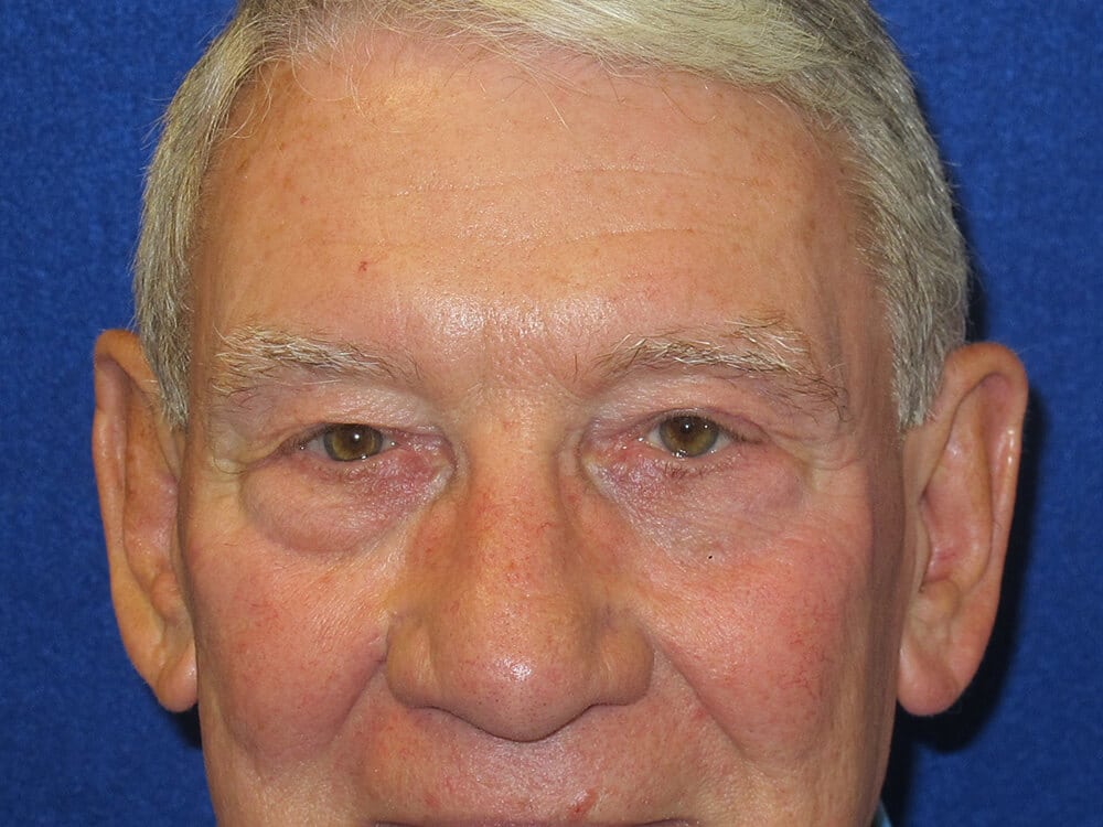 Case--1679 | Before Blepharoplasty