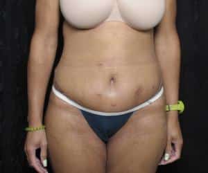 Case--6740 | After Body