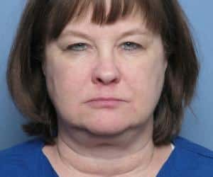 Case--8803 | Before Liposuction