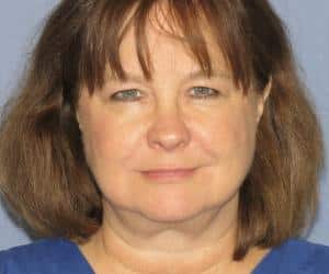 Case--8803 | After Liposuction