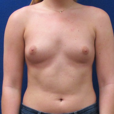 Breast Augmentation - Before