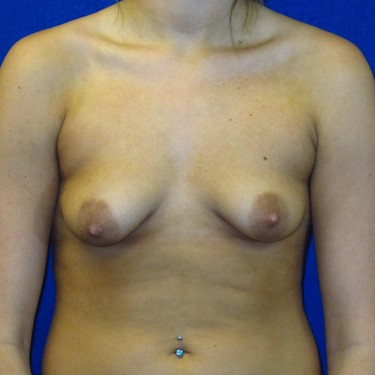 Breast Augmentation with Lift - Before