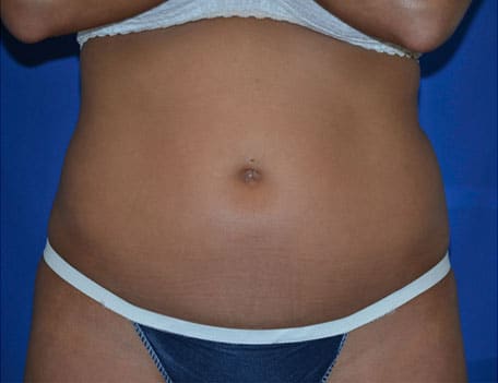 Case--3034 | Before Liposonix