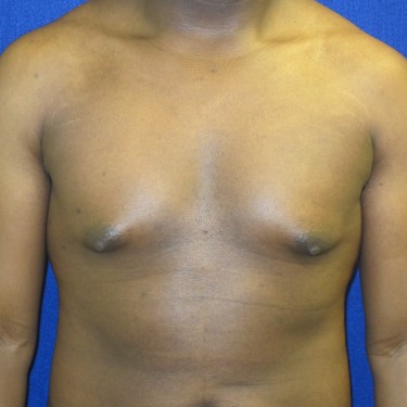 Male Breast Reduction - Before