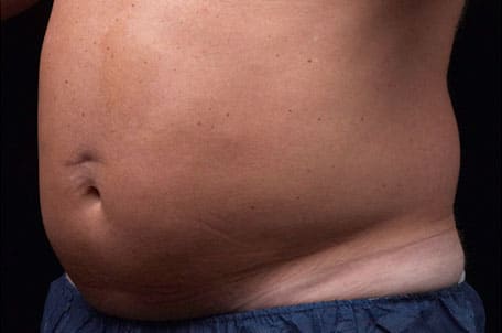 Case--3697 | Before Liposonix