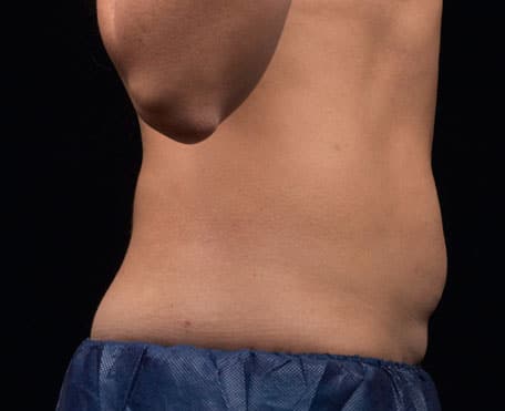 Case--4377 | Before Liposonix