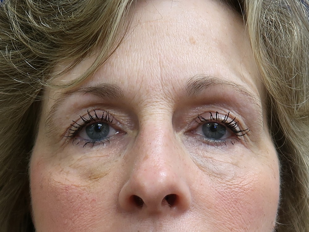 Case--7561 | After Injectables