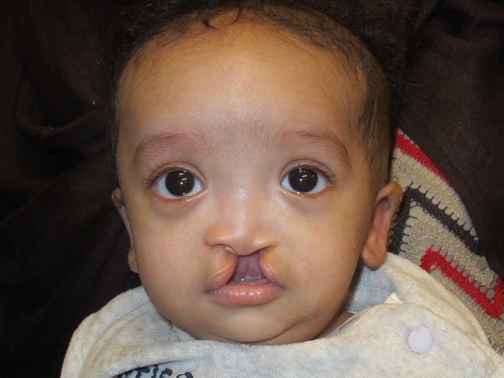 Case--6200 | After EarWell™