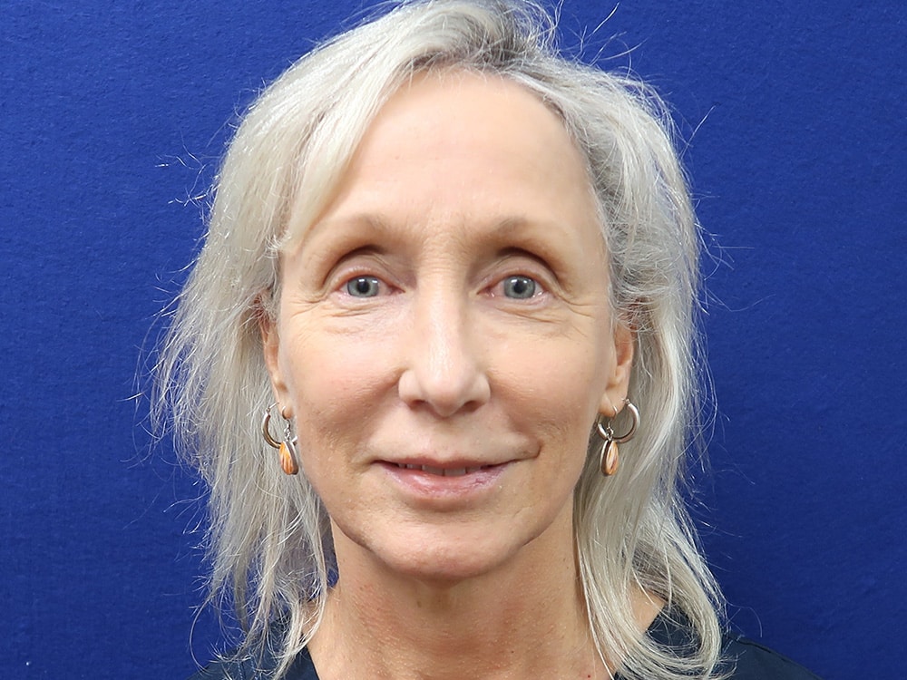 Case--9539 | After Injectables