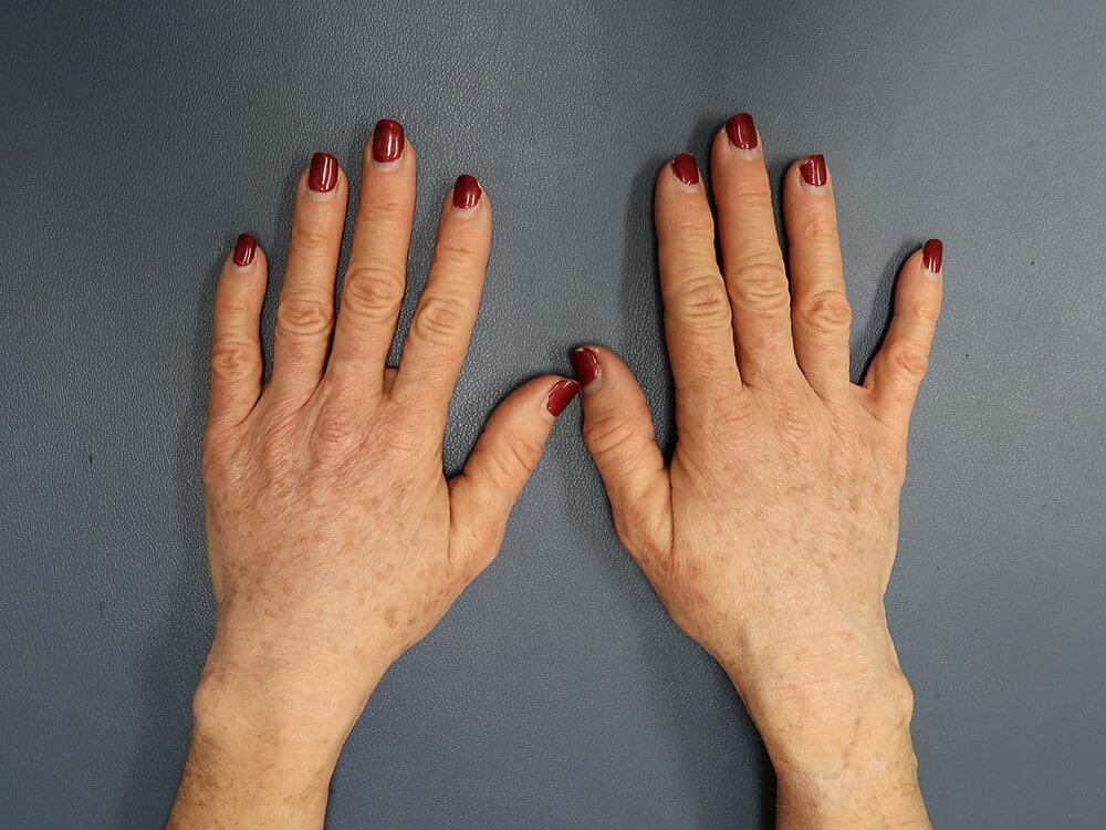 Case--9825 | After Fat Grafting