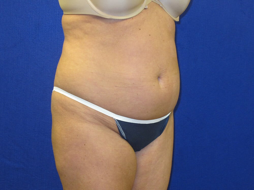 Case--4871 | Before Tummy Tuck