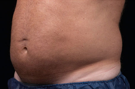 Case--3697 | After Liposonix