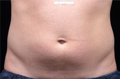 Case--7600 | After Liposonix